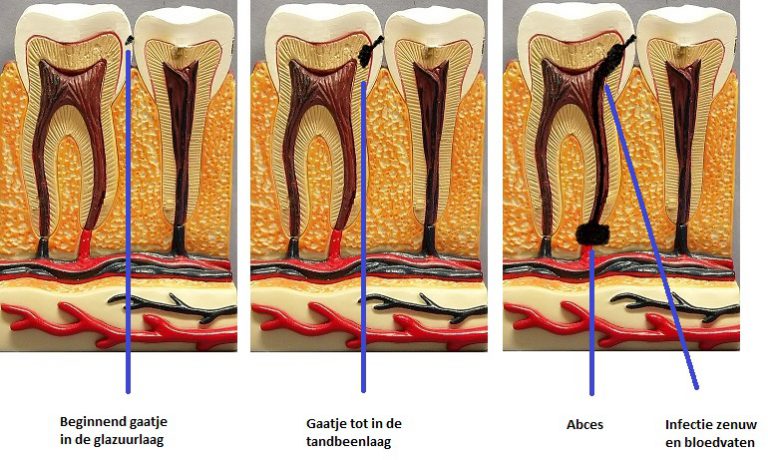 Gaatje, hoe zit dat? - Tandarts Praktijk van der Linde-Molleman