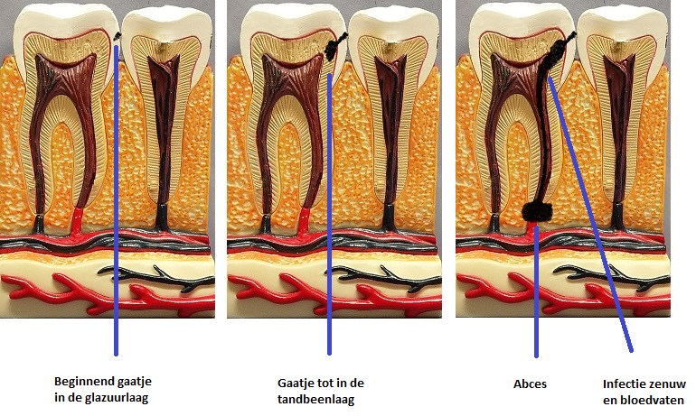Gaatje, hoe zit dat? - Tandarts Praktijk van der Linde-Molleman